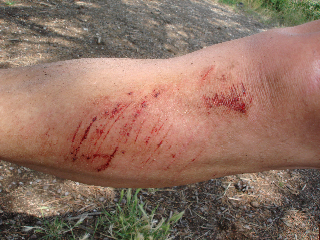 Verletzung ohne Stützredli