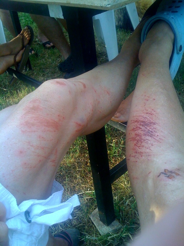 Weitere Verletzung ohne Stützredli