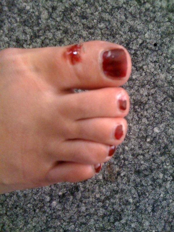 Noch eine Verletzung ohne Stützredli