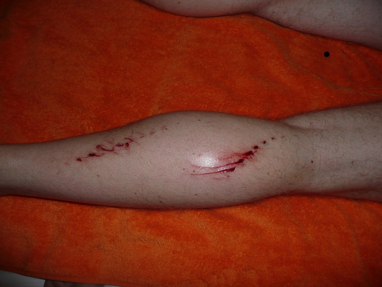 Und noch eine Verletzung ohne Stützredli