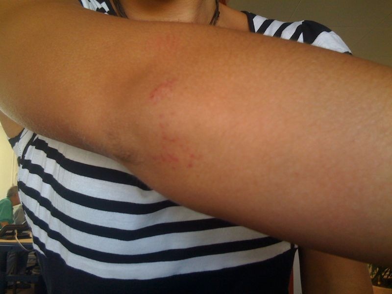 Das könnte allerdings auch ein Mückenstich sein