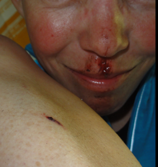 Die erste Gesichtsverletzung ohne Stützredli