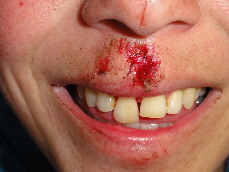 Die erste Gesichtsverletzung ohne Stützredli; Nur für starke Nerven